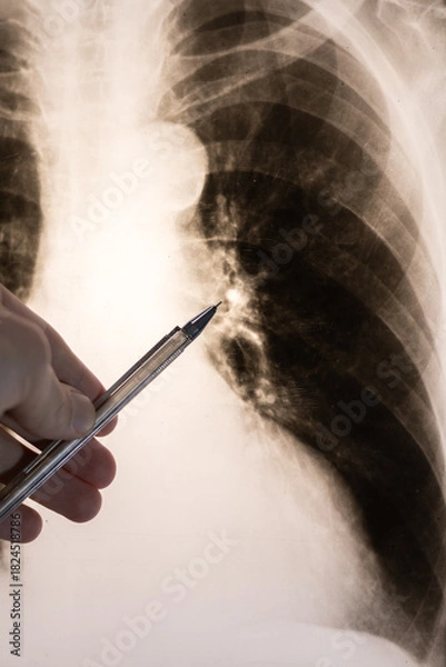 Fototapeta Doctor learn vertical X-ray picture with pneumonia, fluorography. Diagnostics of human lung and respiratory tract diseases.