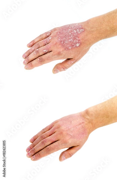 Fototapeta Psoriasis vulgaris on the hand, before and after treatment, isolated on white background. Closeup.