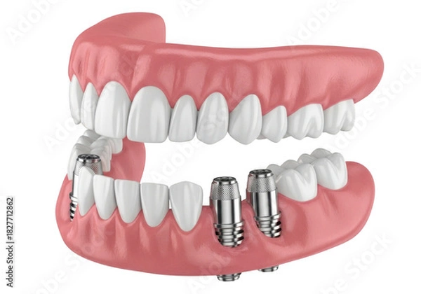 Fototapeta Realistic dental implants and dentures on a transparent background isolated on transparent background