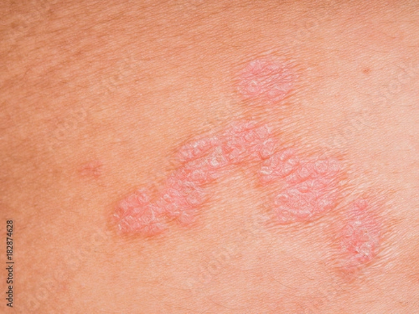 Obraz Psoriasis skin.