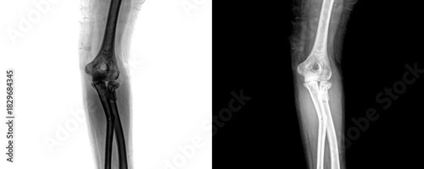 Fototapeta Human Elbow Anterior Projection X-Ray Showing Clear Visualization of Joint, Bones, and Fracture Sites Isolated on Transparent Background
