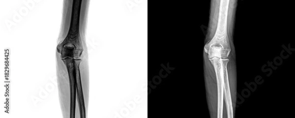 Obraz Medical Elbow Anterior View X-Ray Radiograph Illustrating Bone Integrity and Joint Condition for Detection of Fractures and Trauma Isolated on Transparent Background