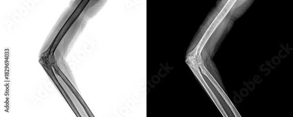 Obraz Elbow Lateral Projection X-Ray Image Displaying Bone Integrity and Joint Orientation for Precise Identification of Fractures Isolated on Transparent Background
