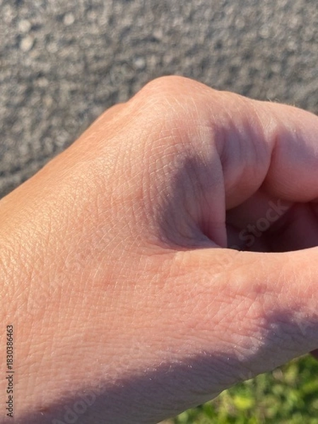 Obraz bolle da orticaria