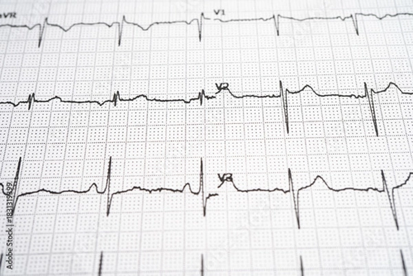 Fototapeta Red heart on electrocardiogram ECG with red heart, heart wave, heart attack, cardiogram report.