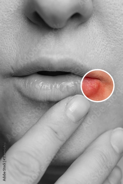 Obraz A person points at a lesion on their lip caused by the herpes virus. The image highlights the need for proper treatment and ways to strengthen immunity against future outbreaks.