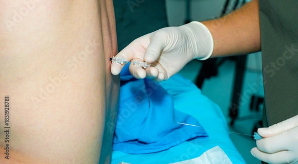 Fototapeta An anesthesiologist administers spinal anesthesia to a patient using a special needle. A close-up of the anesthesiologist's hands, wearing sterile gloves, holding an epidural anesthesia needle.