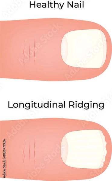 Obraz Healthy Nail vs. Longitudinal Ridging Comparison Vector Illustration
