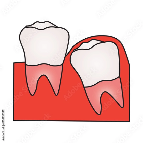 Obraz Impacted Wisdom Tooth and Dental Problem Illustration