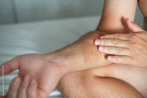 Fototapeta Close-up of an arm wound with applied healing ointment. Concept of first aid, wound care, and treatment of skin injuries.