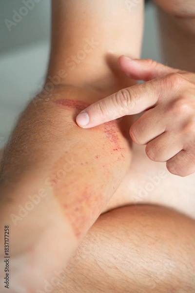 Fototapeta Close-up of an arm wound with applied healing ointment. Concept of first aid, wound care, and treatment of skin injuries.