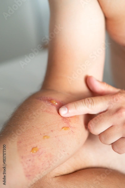 Fototapeta Close-up of an arm wound with applied healing ointment. Concept of first aid, wound care, and treatment of skin injuries.