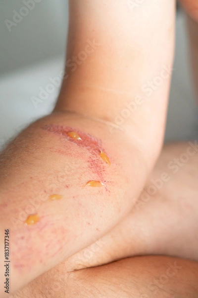 Fototapeta Close-up of an arm wound with applied healing ointment. Concept of first aid, wound care, and treatment of skin injuries.