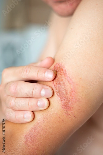 Fototapeta Close-up of an arm wound with applied healing ointment. Concept of first aid, wound care, and treatment of skin injuries.