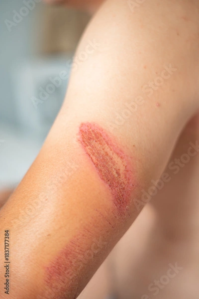 Fototapeta Close-up of an arm wound with applied healing ointment. Concept of first aid, wound care, and treatment of skin injuries.