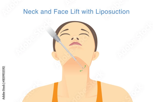Obraz Neck and Face lift with Liposuction. woman lifts her head to allow the Cannula needle to be inserted under her chin for liposuction. Reducing excess body fat with medical technology.