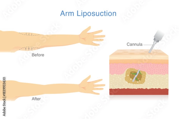 Obraz Reduce excess arm fat with Liposuction. Woman make sagging arm look firmer and more beautiful. Skin layer showing Cannula removes excess fat from the inner layers of the skin.
