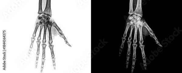 Obraz Hand Anterior View X-Ray Radiograph Showing Detailed Bone Alignment and Phalange Structure for Accurate Diagnosis of Hand Fractures Isolated on Transparent Background
