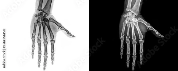 Obraz Hand Anterior Projection X-Ray Image Displaying Metacarpal and Phalangeal Bones for Detection and Evaluation of Fractures Isolated on Transparent Background