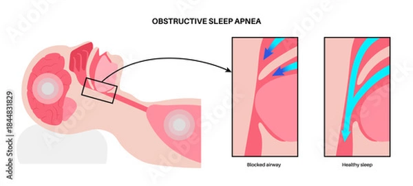 Obraz Obstructive sleep apnea