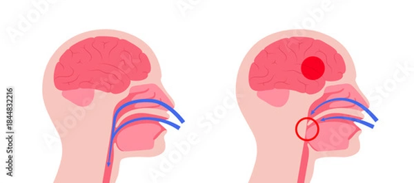 Obraz Obstructive sleep apnea