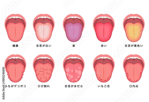 Obraz 舌でわかる健康状態　舌診　舌の健康
