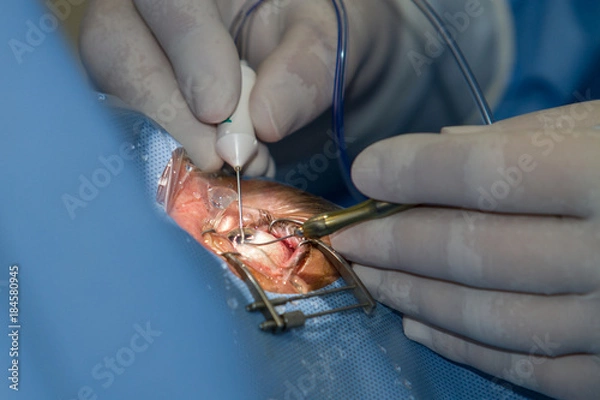 Fototapeta Zagreb, Croatia - June 12, 2017: Eye surgery in the hospital, eye and diopter correction. In the operation of the gray star, the torn lens is surgically replaced by an artificial lens implant