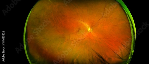 Obraz eye's retinal angle image with macula, vessels and optic disc isolated view on a black bacground. made by ultra wide fundus camera
