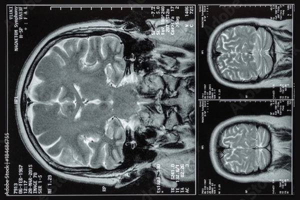 Obraz Photo MRI ,MRA,of the brain