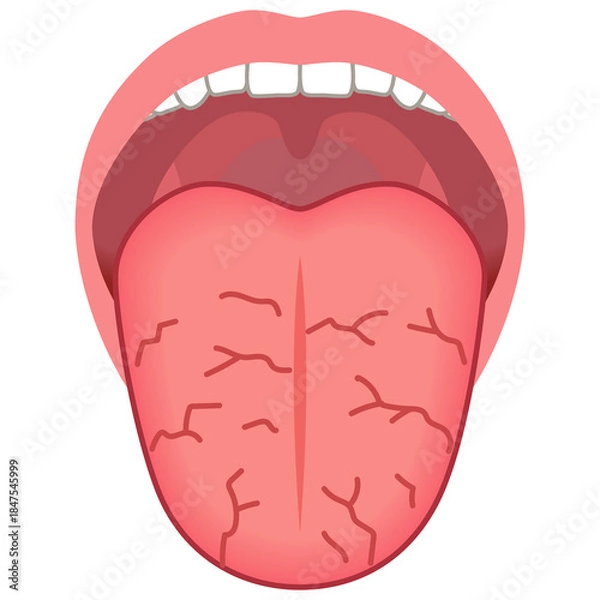 Obraz ひび割れた舌　舌でわかる健康状態　舌診　舌の健康