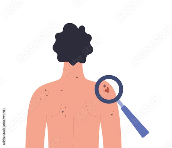 Obraz Dermatology screening. Dermatoscopy examination. Skin cancer diagnosis of a man. Healthcare vector illustration