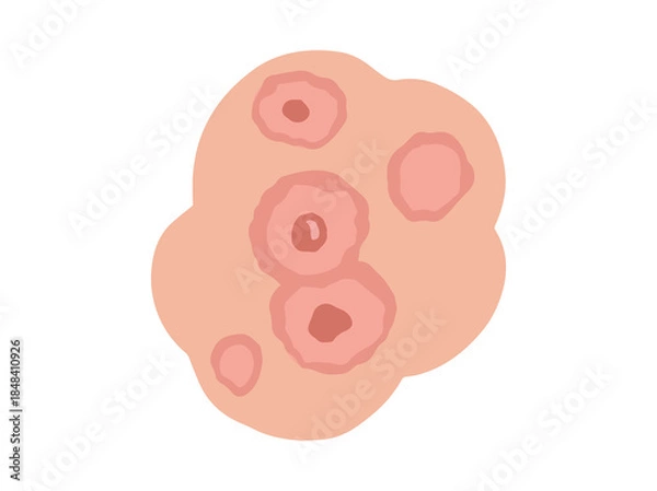 Obraz Hand Drawn Erythema Multiforme Redness

