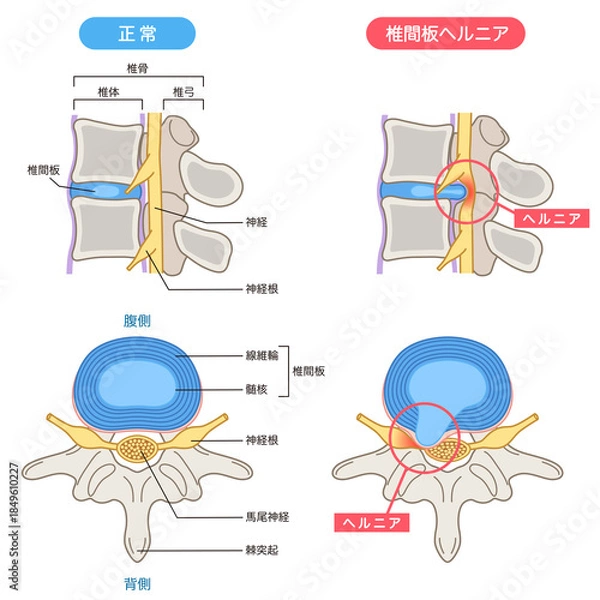 Obraz 腰椎椎間板ヘルニア　椎間板の構造　腰痛