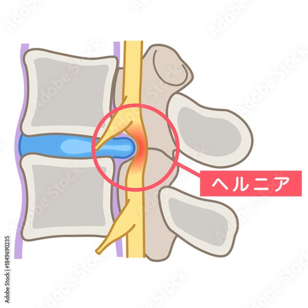 Obraz 腰椎椎間板ヘルニア　椎間板の構造　腰痛