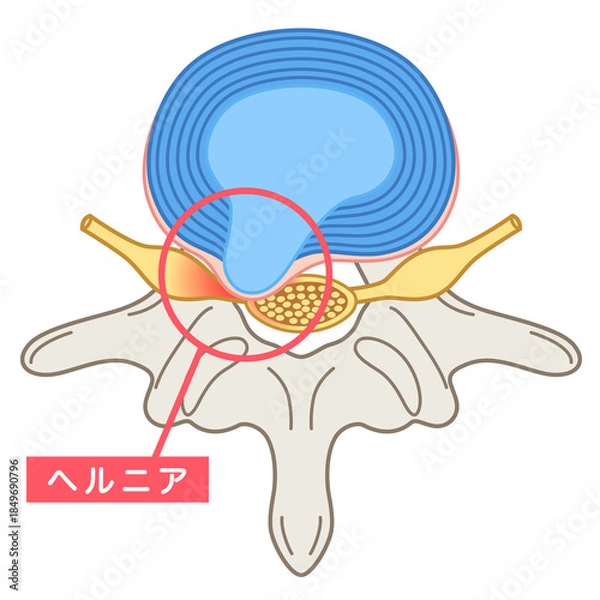 Obraz 腰椎椎間板ヘルニア　椎間板の構造　腰痛