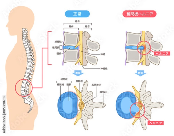Obraz 腰椎椎間板ヘルニア　椎間板の構造　腰痛