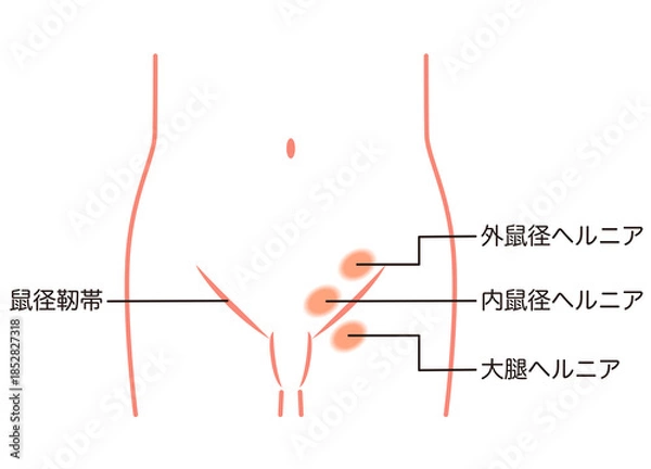Obraz 鼠径ヘルニアの種類　ヘルニア　股関節