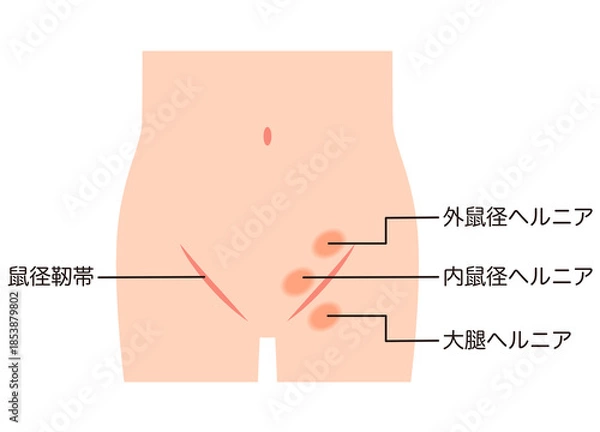 Obraz 鼠径ヘルニアの種類　ヘルニア　股関節