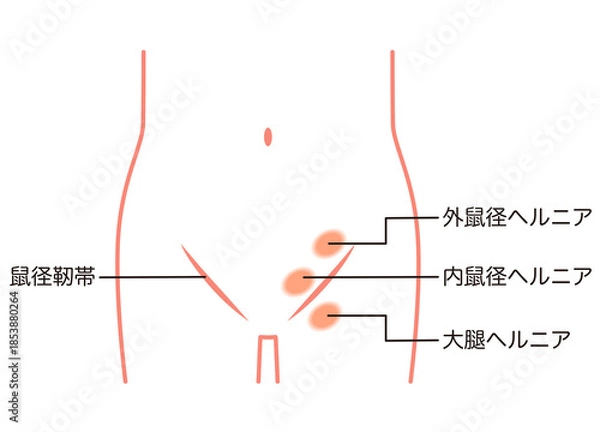 Obraz 鼠径ヘルニアの種類　ヘルニア　股関節