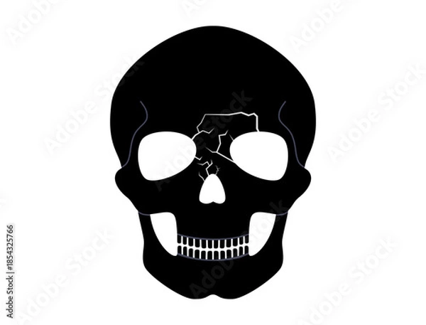 Obraz Nasal fracture poster