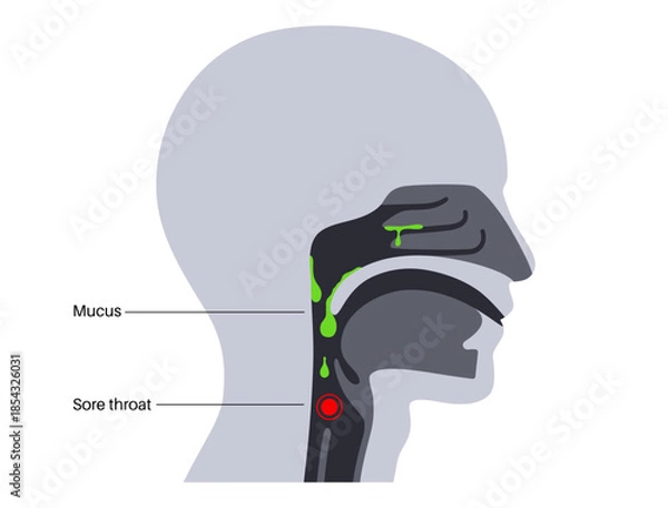 Obraz Postnasal drip poster