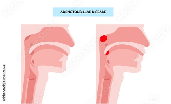 Obraz Adenotonsillar disease poster