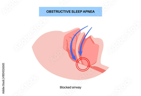 Obraz Obstructive sleep apnea