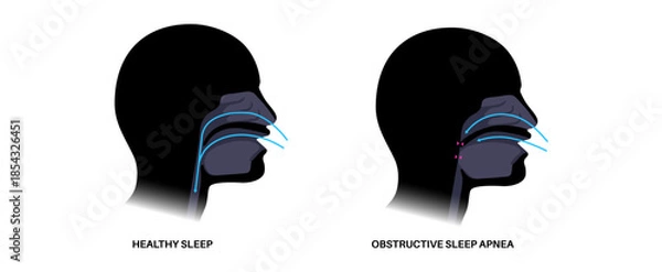 Obraz Obstructive sleep apnea