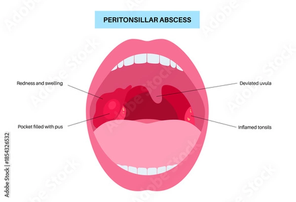Obraz Peritonsillar abscess poster