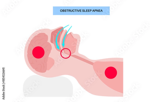 Obraz Obstructive sleep apnea