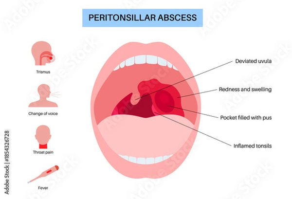 Obraz Peritonsillar abscess poster