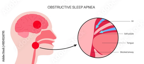 Obraz Obstructive sleep apnea
