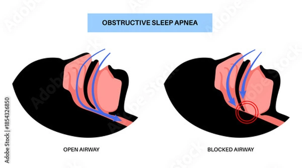 Obraz Obstructive sleep apnea