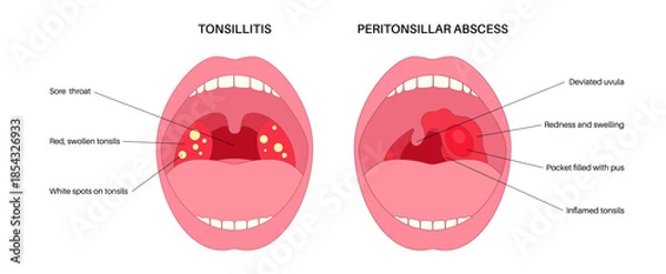 Obraz Peritonsillar abscess and tonsillitis